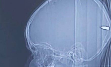 Des chirurgiens israéliens retirent une balle logée dans le cerveau d’un enfant arabe
